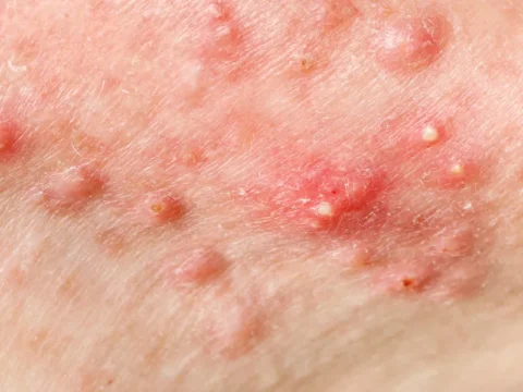 טיפול באקנה